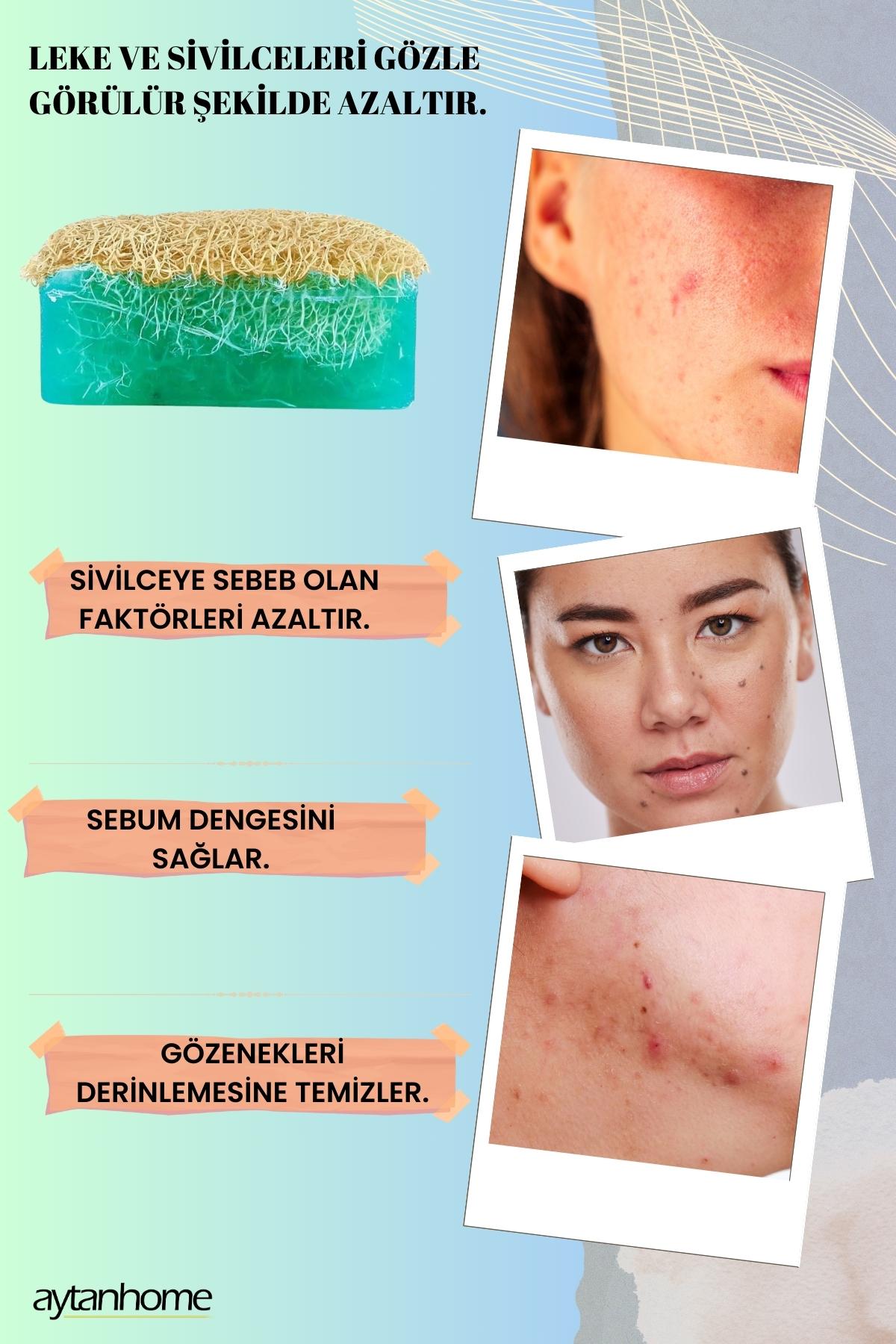 Toptan Anti-Acne Sabunu Sivilce Akne Karşıtı